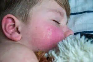 atopijski dermatitis kod dece
